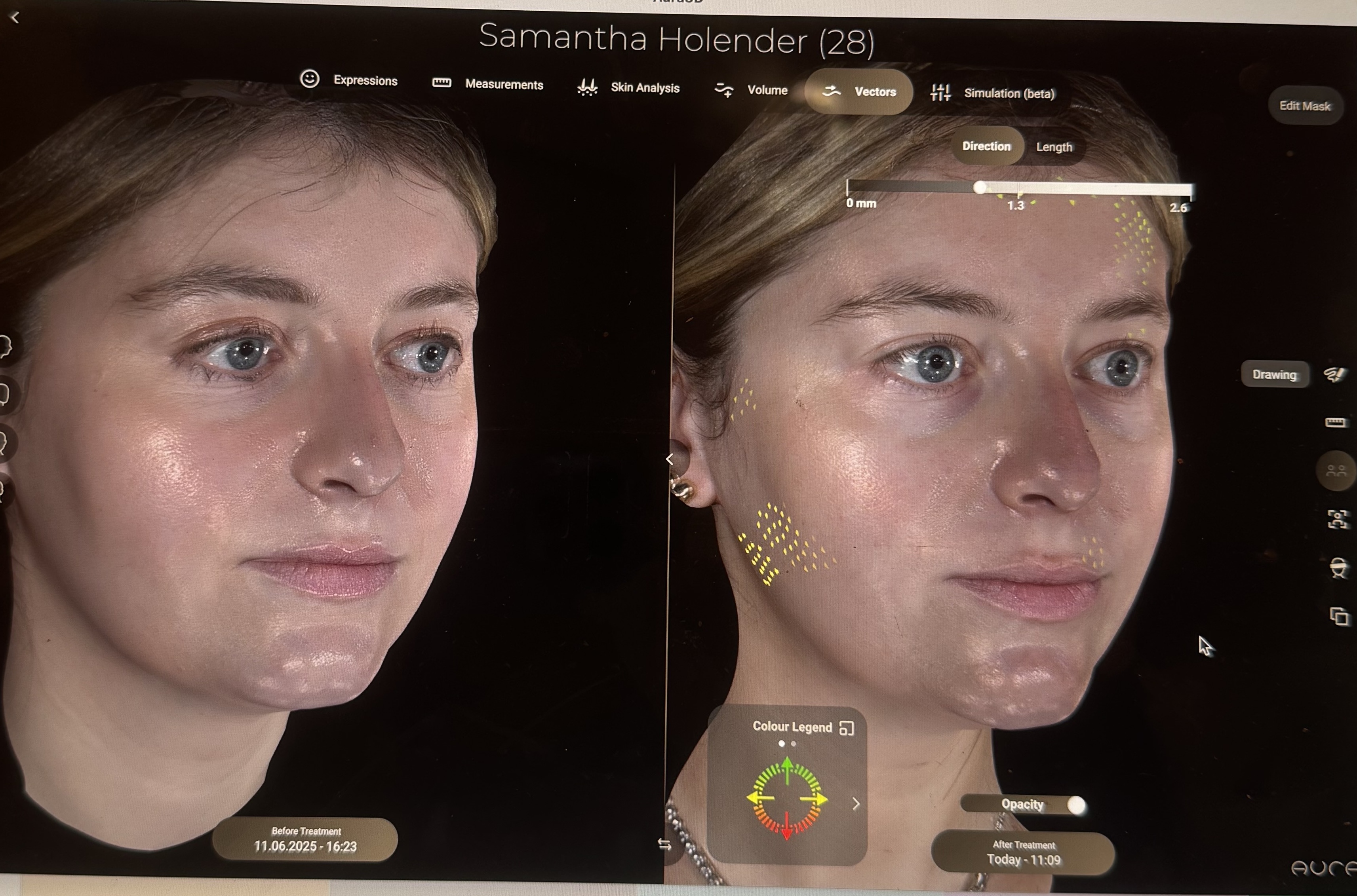 samantha holender before and after sofwave treatment