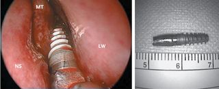 On the left, the dental implant inside the patieint's sinus. On the right, the impant after it was extracted.