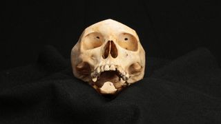 This skull shows the characteristic marks of transorbital lobotomy, also called, in its time, icepick lobotomy. The small, symmetrical holes in the eye sockets are where a surgical tool perforated the skull.
