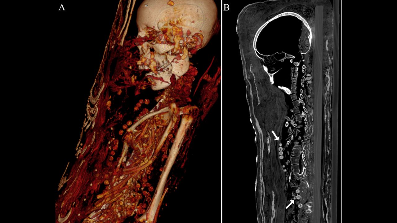 The CT scan showed the beads from the necklace around the woman's neck and body.