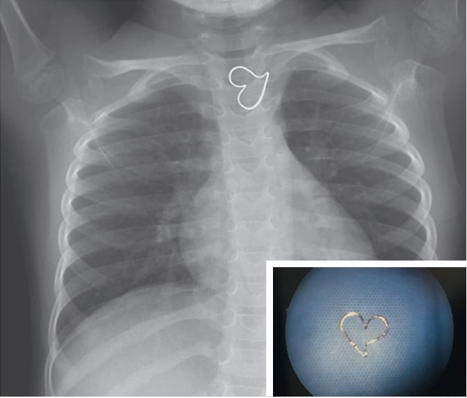 A &quot;heart-shaped foreign body&quot; appeared on a child&#039;s X-ray after she swallowed a metal pendant.