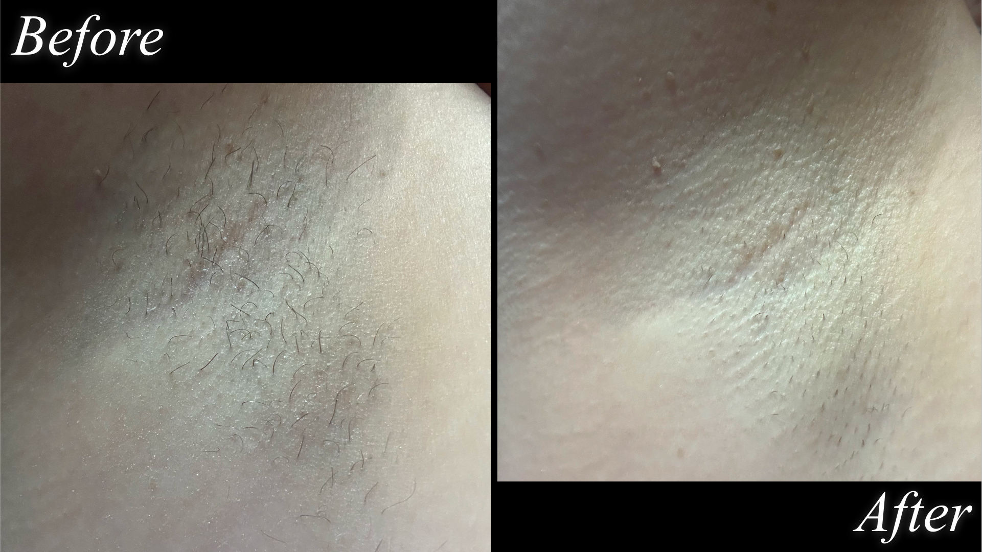 Split image of brooke knappenberger armpit before and after testing Nood Flasher 2.0 laser hair removal device