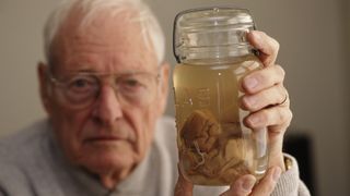 Thomas Harvey holds up Einstein's brain in a jar