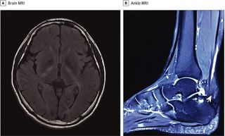 Lumps on a man's Achilles tendon were an early sign of a serious metabolic disease, called cerebrotendinous xanthomatosis, that also affects the brain. Above, MRIs of the patient's brain (A) and ankle (B). The arrowhead in image B points to an enlargement on the patient's Achilles tendon that tapers at the end.