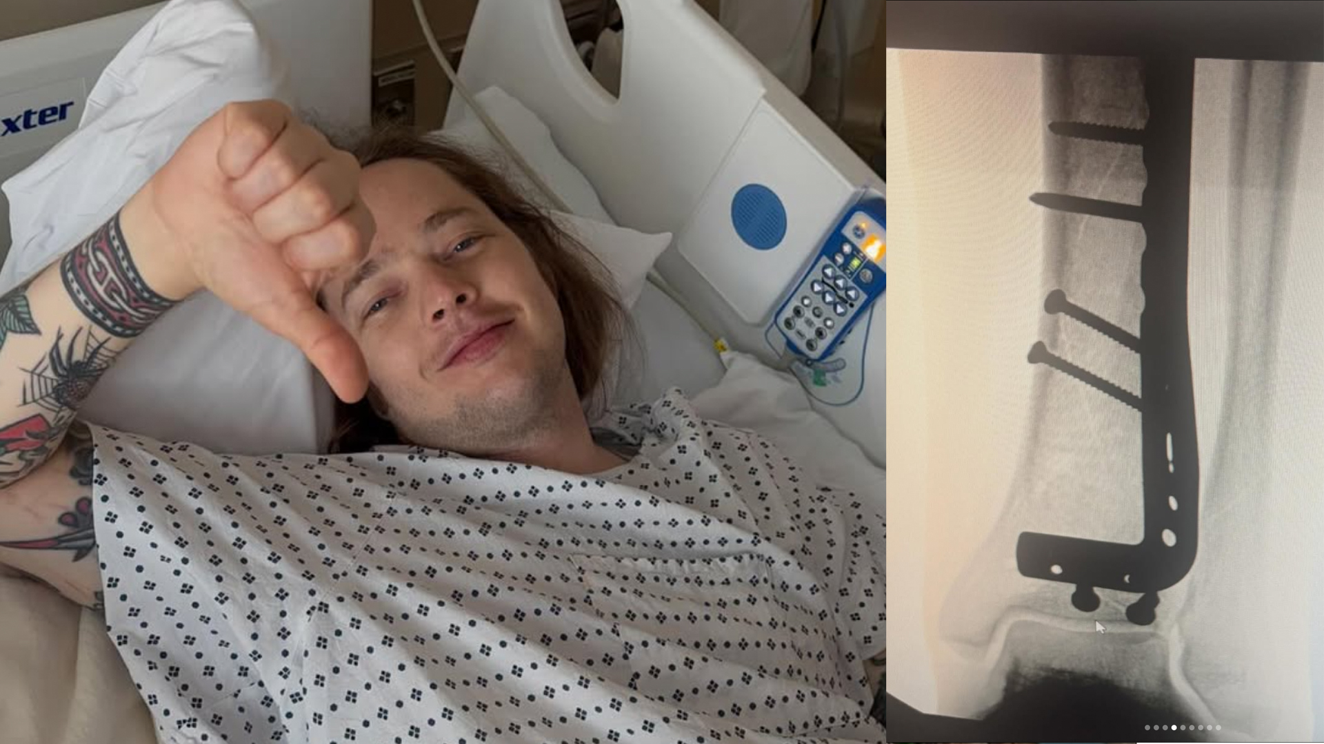 A composite photo showing Billy Strings resting in a hospital bed after breaking his leg, alongside an X-ray of his leg post surgery with screws holding the bone together.