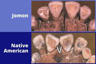 A comparison highlighting the difference between Jomon and Native American teeth.