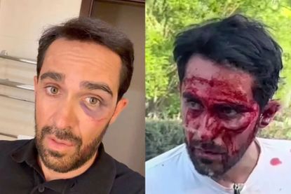 Alberto Contador before and after stitches after his crash