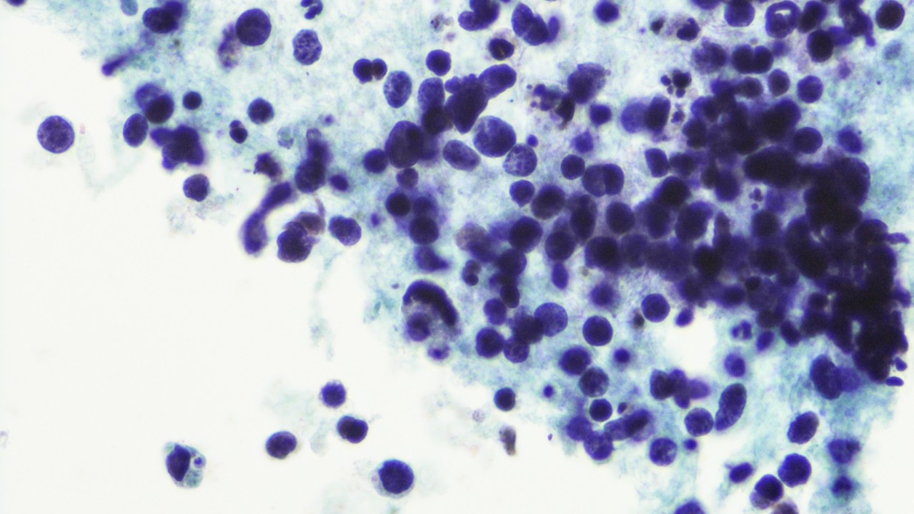 Micrograph of small cell lung cancer