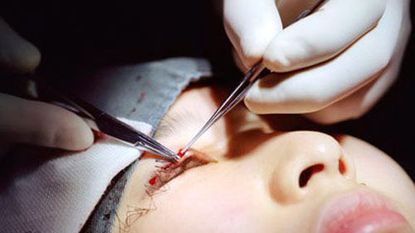 photograph of woman undergoing eyelid surgery