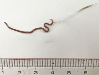 A 1.5-inch parasitic worm, known as Pseudoterranova azarasi, was removed from a woman's tonsil.
