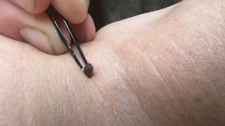 Tick stuck in arm