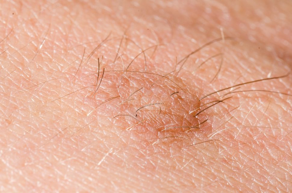 What Causes Skin Tags? Acrochordon Live Science