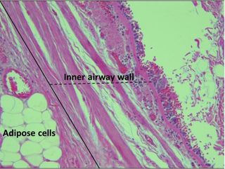 A new study finds that fat accumulates in the airways of the lungs. Above, an image showing a lung tissue sample under a microscope. Fatty tissue, or adipose cells, can be seen in the outer wall of the airway.