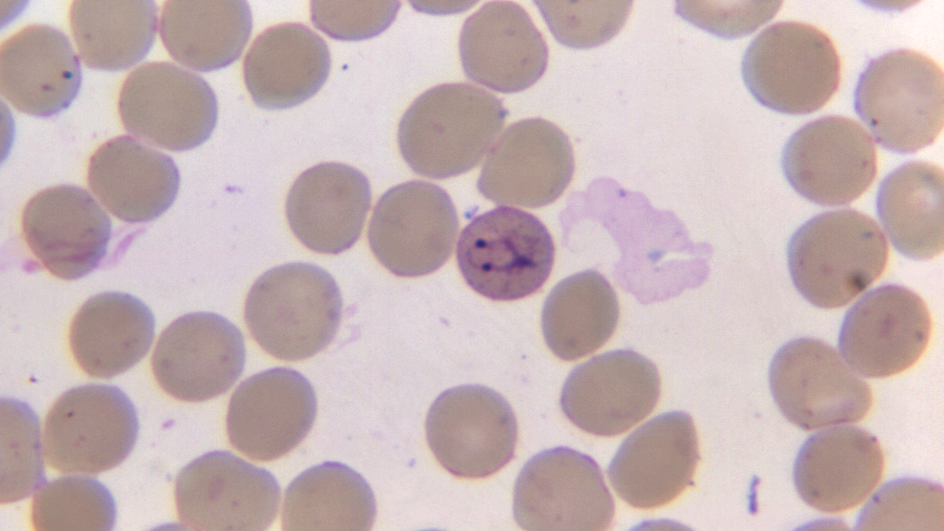 A picture of a film blood smear from a patient that was having treatment for malaria.