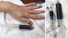 Woman's blue fingernails and vials of drawn blood