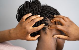 Woman with itchy scalp needing home treatments for dandruff