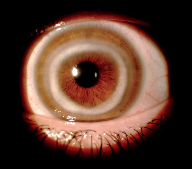 An unusual white ring in the front of a woman&#039;s eyeball was the result of a rare condition. Above, an image of the patient&#039;s eye showing the ring around the edge of the cornea.