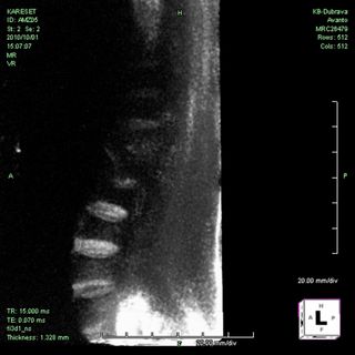 The recently developed MRI technique allowed the researchers to get an up-close look at the inter-vertebral disks of the mummy's spine.