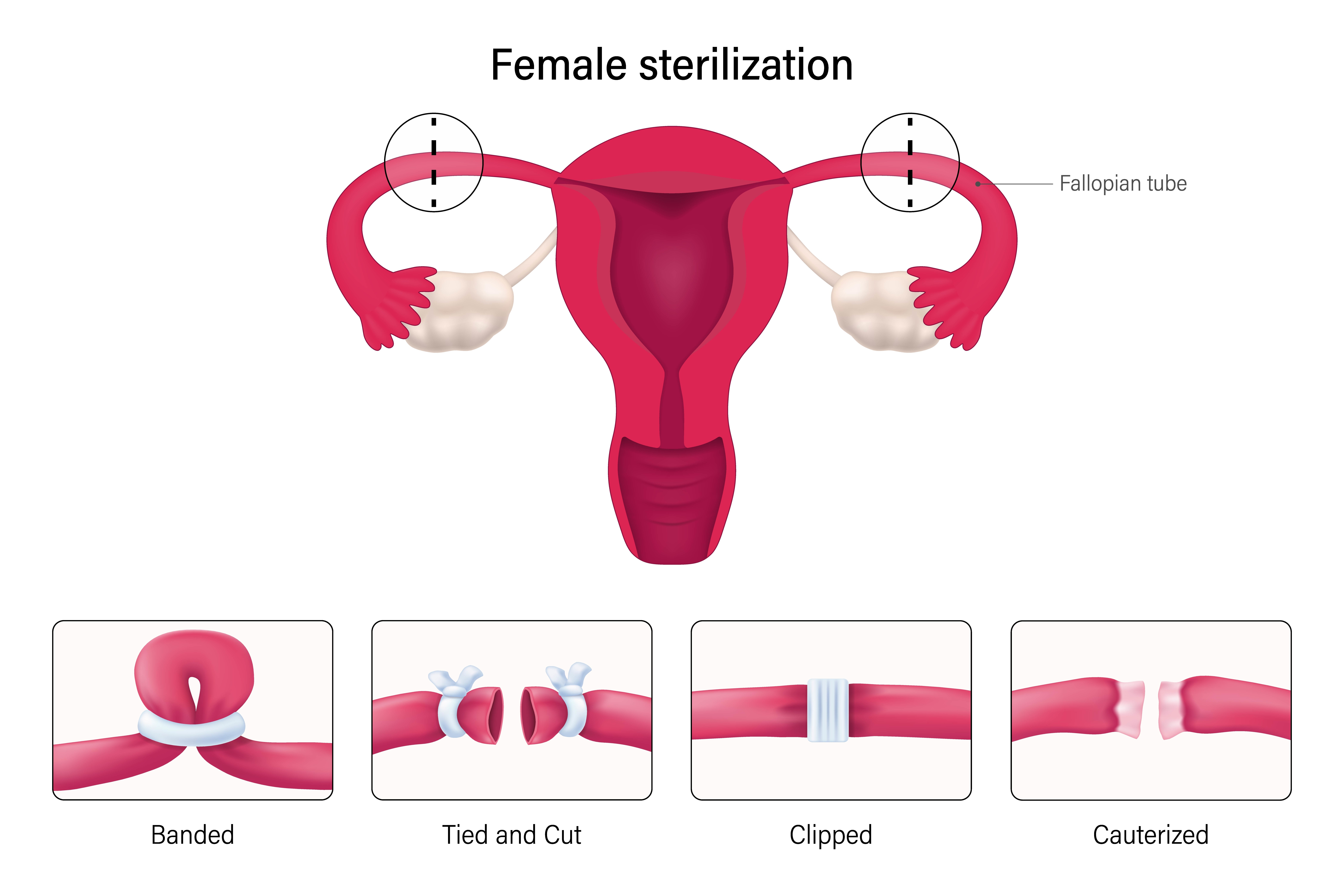 A cartoon shows the different types of tubal ligation that block the tubes by either banding, cutting and tying, clipping or cauterizing them.