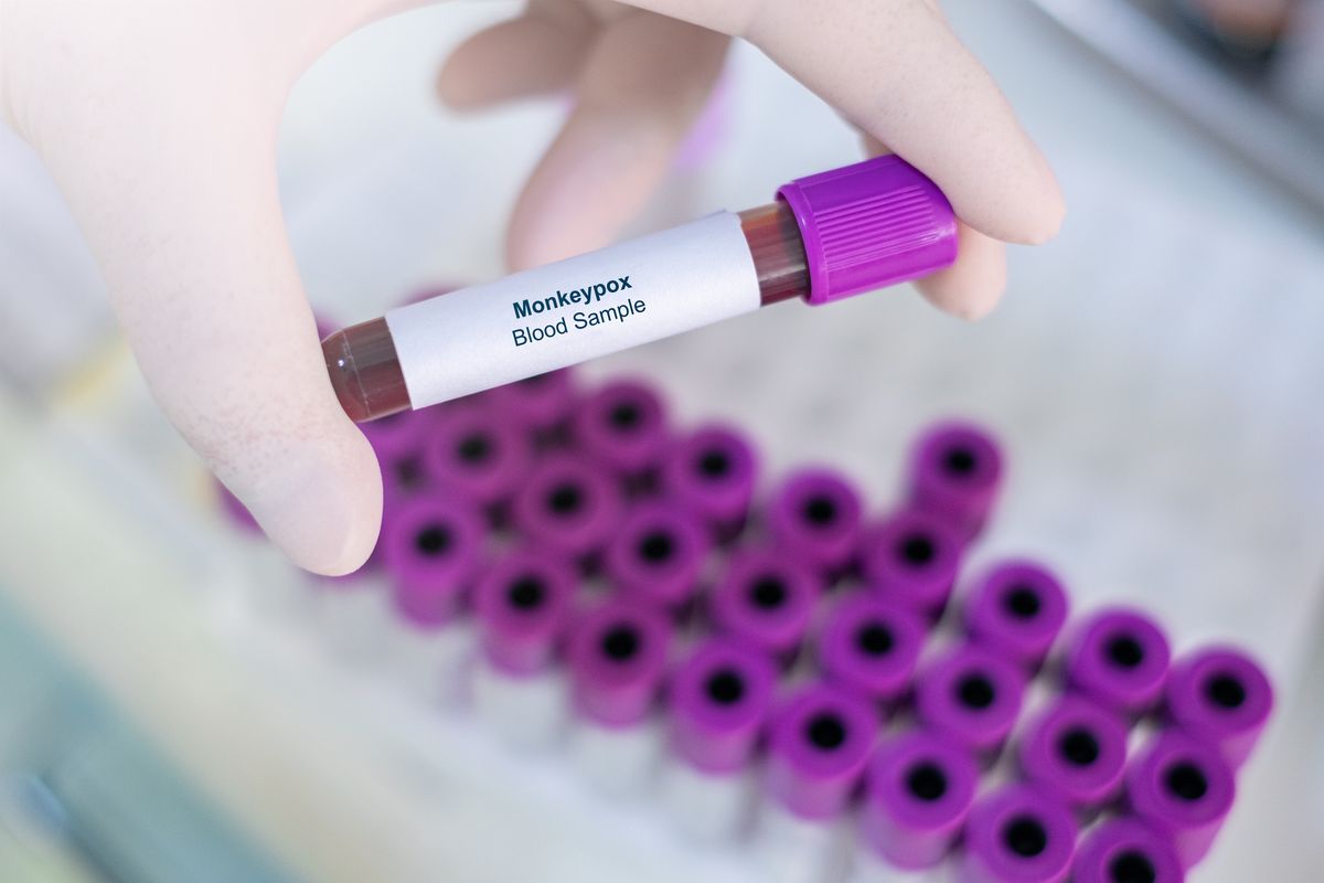 1st U.S. monkeypox death confirmed in Los Angeles County The Week